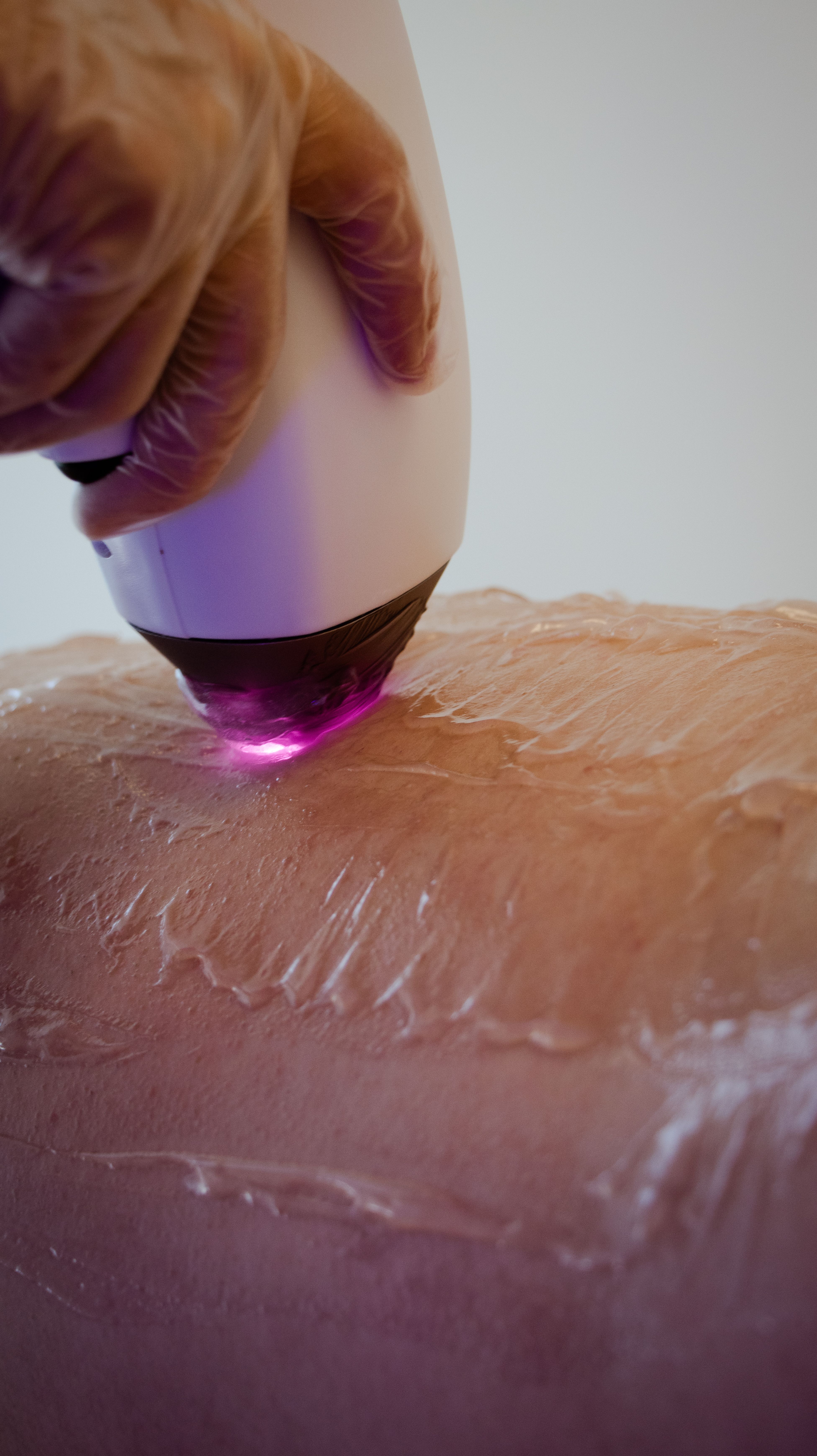 Sessão de depilação a laser